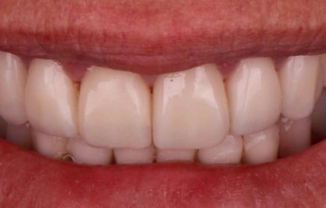 Img-before-and-after - AFTER 4