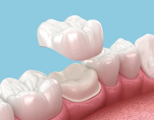 Modern Dental Crowns for Tooth Protection