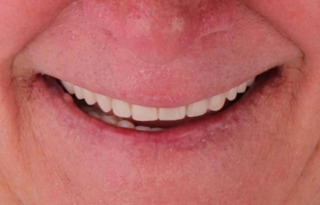 Img-full-mouth-reconstruction- AFTER 1