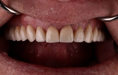 Img-full-mouth-reconstruction- AFTER 2