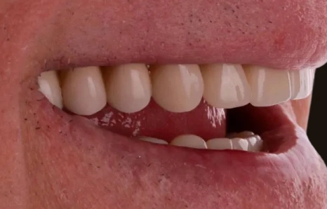 Img-full-mouth-reconstruction- AFTER 3