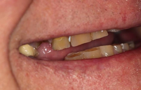Img-full-mouth-reconstruction- BEFORE 3