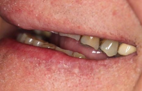 Img-full-mouth-reconstruction- BEFORE 4