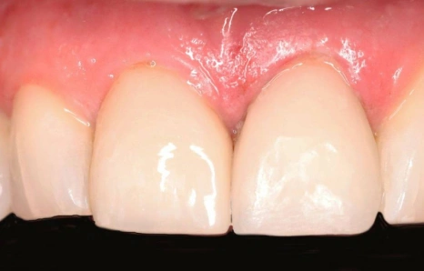 Img-porcelain-veneers- AFTER 2
