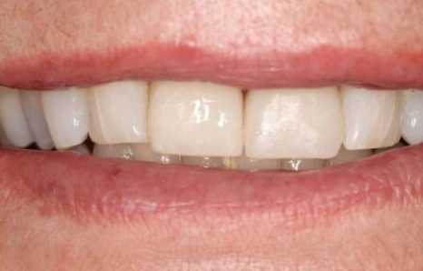 Img-porcelain-veneers- AFTER 3