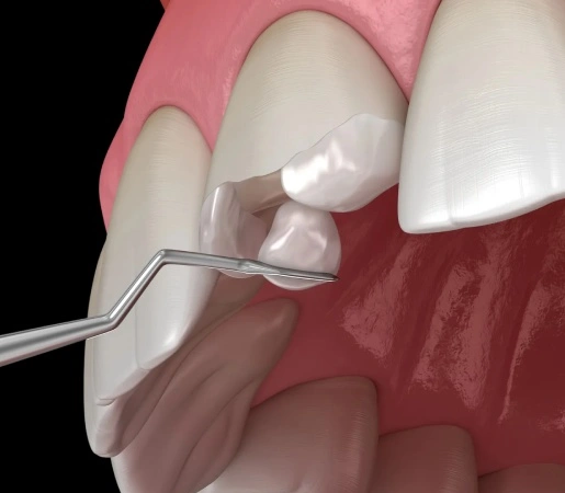 chipped-tooth-repair